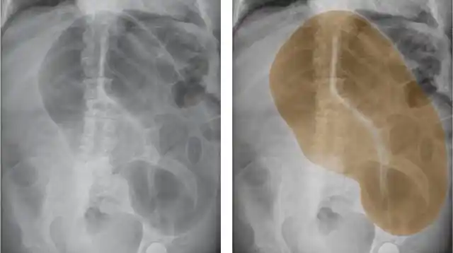 下面我们来看个例子:上为盲肠扭转的图解,盲肠扭转造成盲肠梗阻和肠道