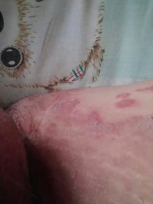 帮忙看看什么病特别痒,有时候晚上睡不着,刚开始是大腿内侧痒,现在