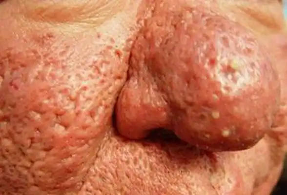 鼻子长螨虫症状图片 (57)