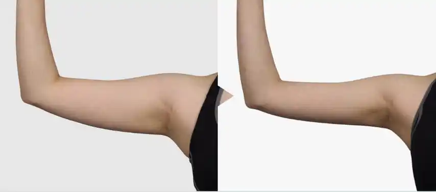 手臂吸脂前后对比