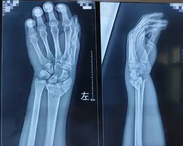 桡骨远端粉碎性骨折