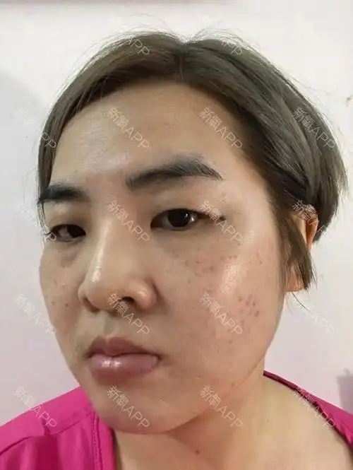 韩国gng免费整形招募新氧昵称:肉丝哇哇_圈子-新氧美容整形