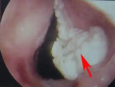 右声带乳头状瘤癌变