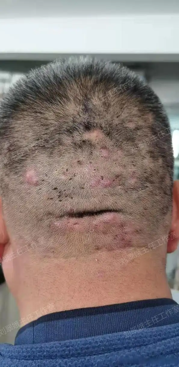 毛囊炎,长在头上这样的大红疙瘩,青壮年比较容易得.