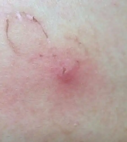 前两天摔到地上胸口处划伤了点,现在大部分已结痂,但是有一小块地方