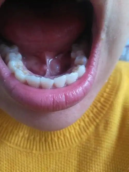 一般舌头系带旁边有两个小疙瘩,我有一边变成泡了,一吃刺激性东西就变