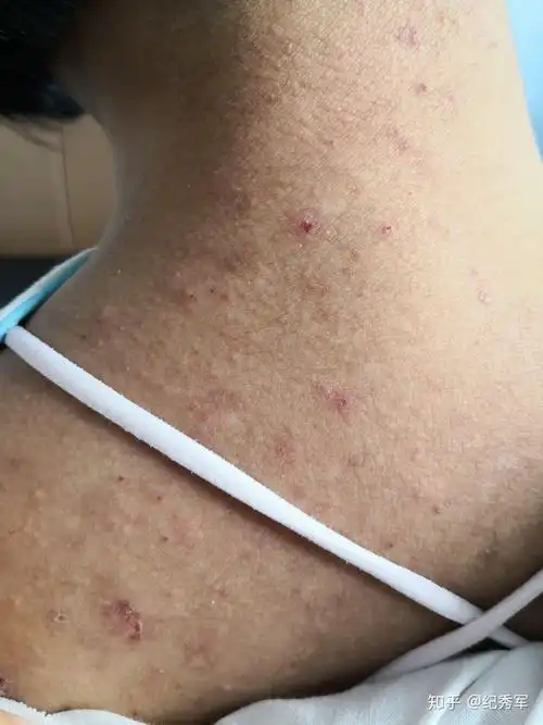 糠秕孢子菌毛囊炎1例 - 知乎