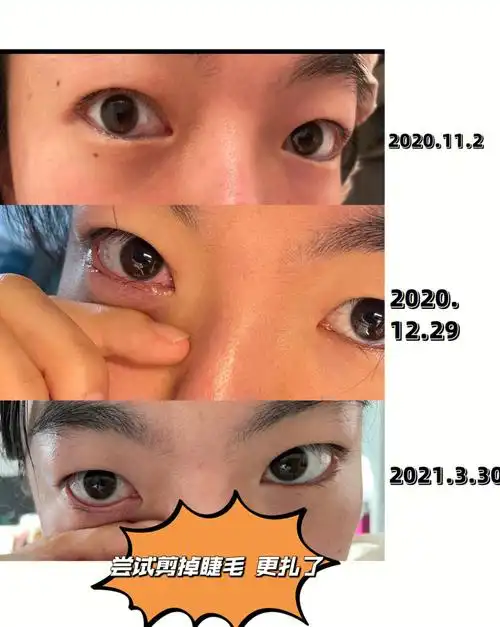 终于做了倒睫手术后悔没早点下决心