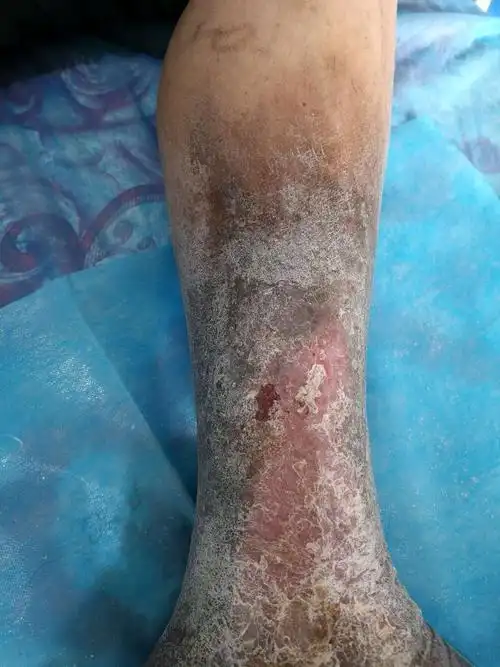 多年老烂腿治疗前后效果对比