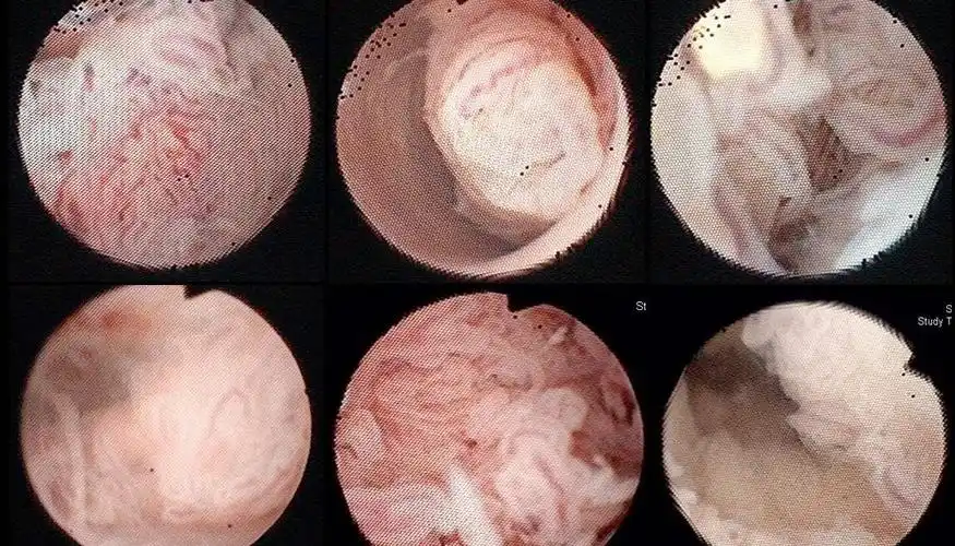 除开刮宫还有另外解决内膜厚的方案吗?-孕多多