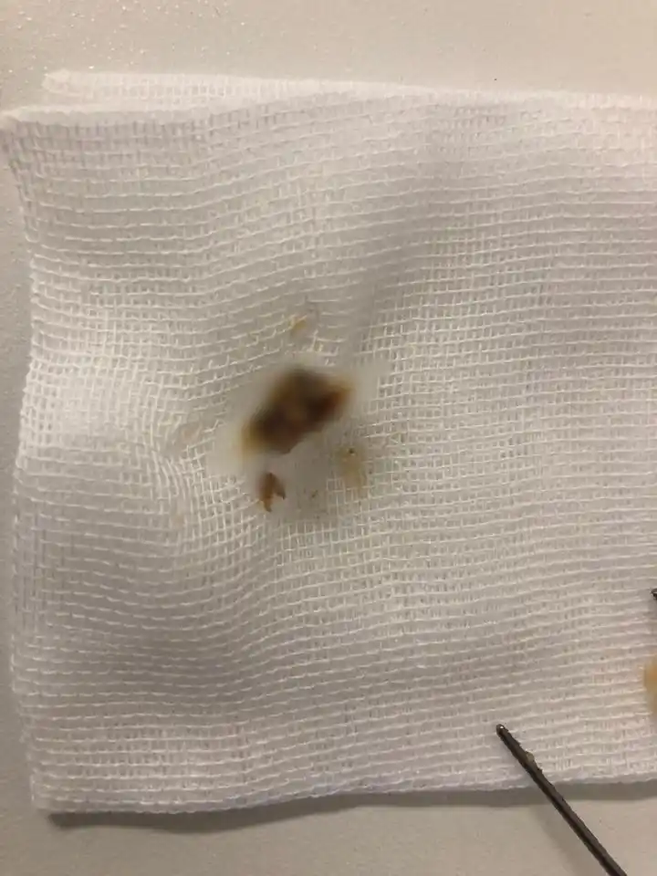 昨夜急诊一夜醒来左耳听不见了医生从她耳朵里挖出一大坨黑色物体