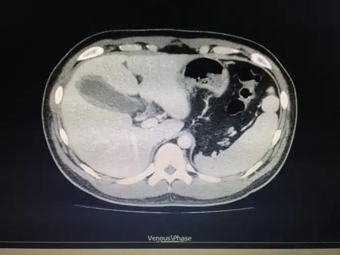 ct胆囊炎,未见结石.