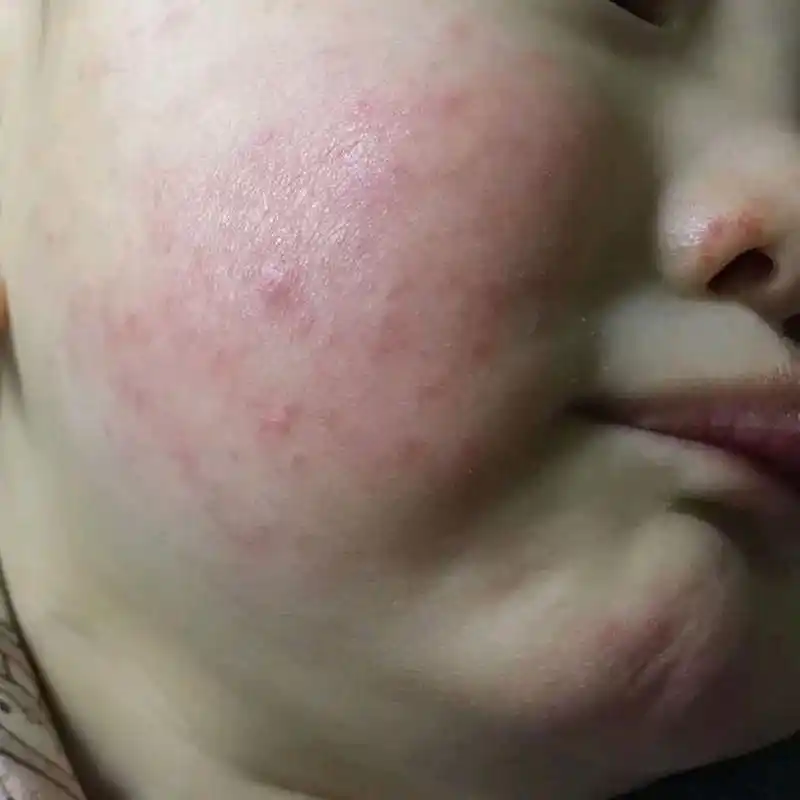 激素类药膏是可以合理用的,这也是治疗湿疹的一线用药,只要你按照