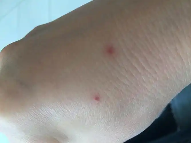 乙肝蜘蛛痣早期图片 (40)