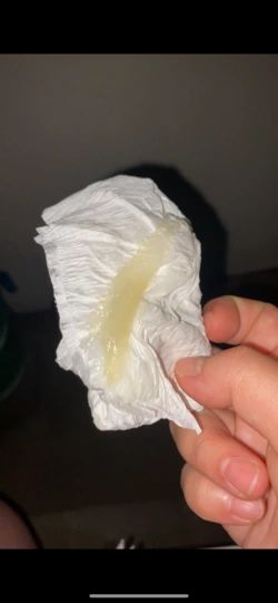 如果大家发现大量这样的分泌物时要注意了这是宫颈黏液一般在临产前