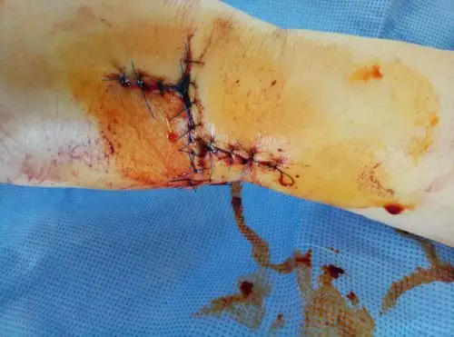 全身多处刀砍伤