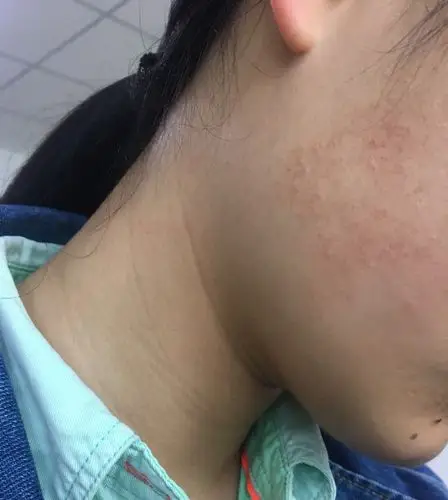 脸颊两边长小颗粒是怎么回事啊?有什么办法可以消除?