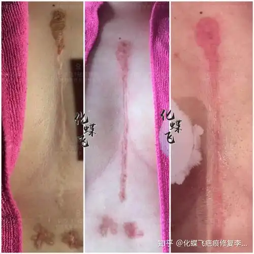 开胸手术疤痕太大了