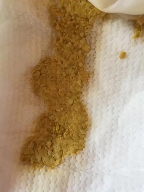 宝宝最近拉大便黄色的,带有白色颗粒状的物质,混合喂养,这是什么情况?