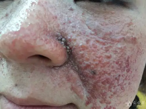 (皮肤病)结节性硬化病一例! 如图 - 全科医疗专业讨论版 - 爱爱医医学