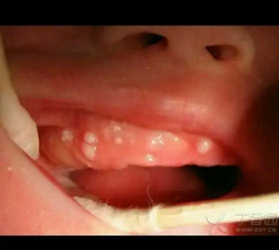 新生儿常见症状之---马牙