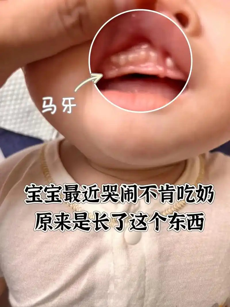 马牙,也称"板牙",医学上叫做"上皮珠",主要