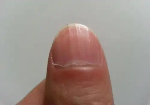 3/6    缺乏维生素a    指甲上有竖纹也可能是缺乏维生素a的表现,这个