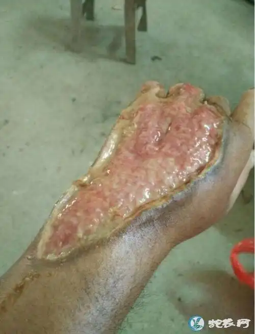 可是下一秒却被咬伤大腿了被眼镜王蛇咬伤大腿的大爷不知道现在是否