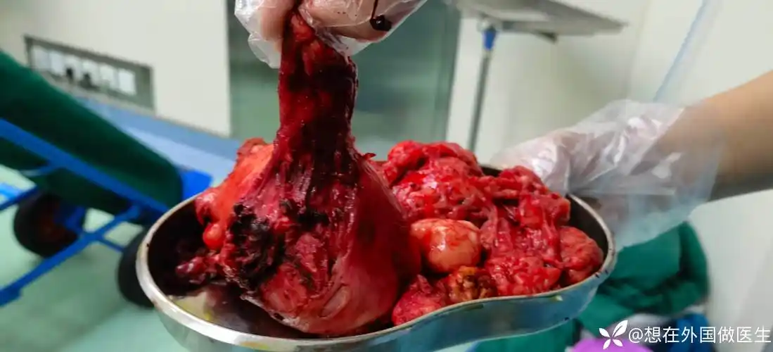 腹腔镜大子宫切除图例