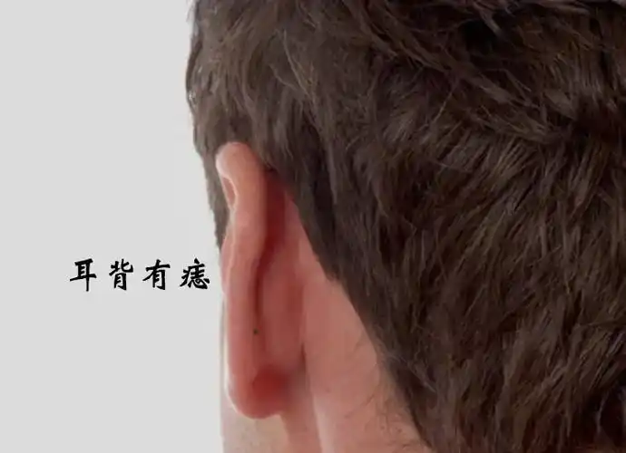 你的耳朵后面有没有长痣呢?