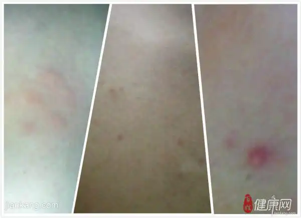 如下:艾滋病皮疹特征的特点是大,小片粒红,有时会痒,有时不会痒.