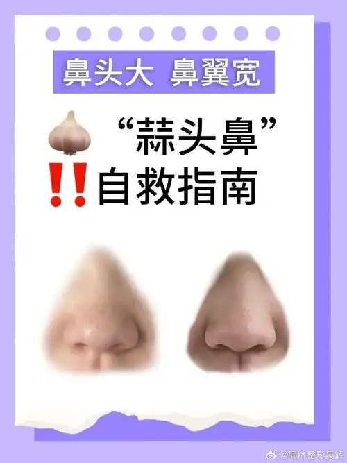 蒜头鼻##鼻整形##隆鼻手术##鼻综合##隆鼻