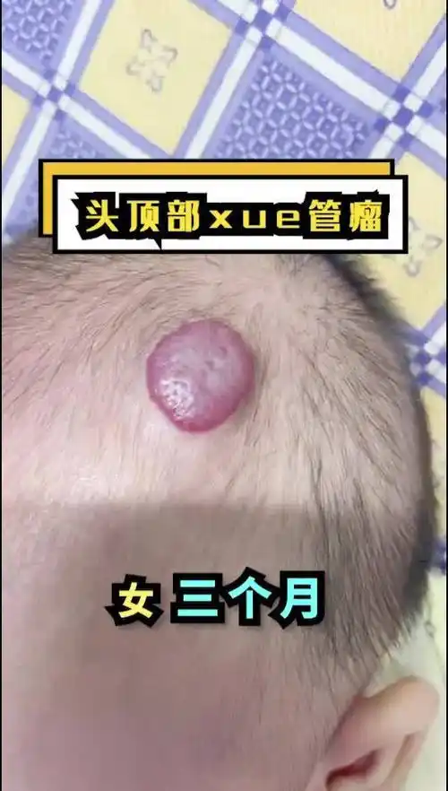 孔强分析头顶部血管瘤血管瘤