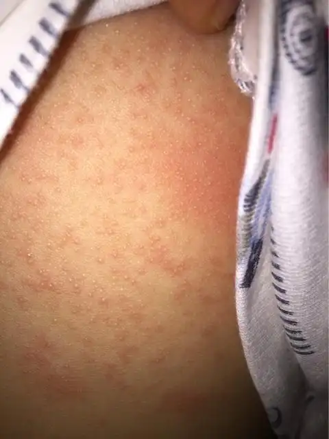 宝宝背上突然发出来像痱子一样的一片
