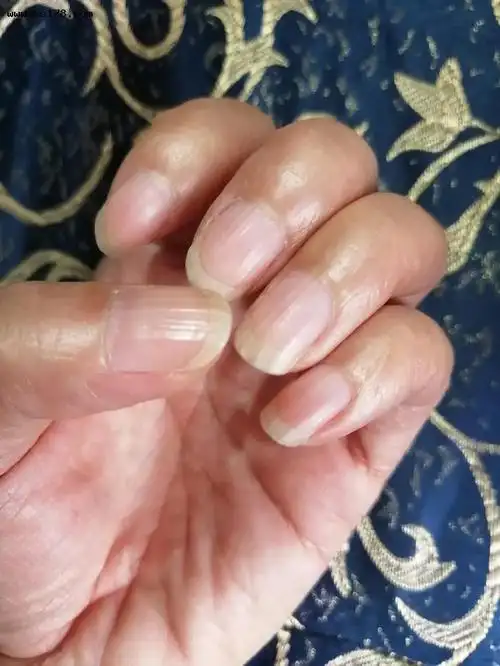 指甲竖纹是怎么回事