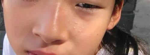 小孩脸上的疣状物