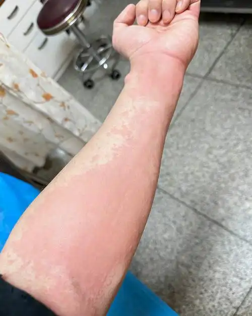 是属于典型的"肠胃型荨麻疹",常见症状就是皮肤上出现大片红色风团