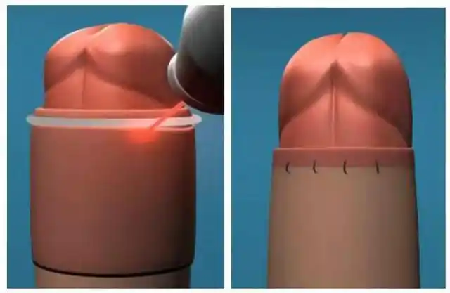 包皮系带手术(包皮系带手术多少钱)