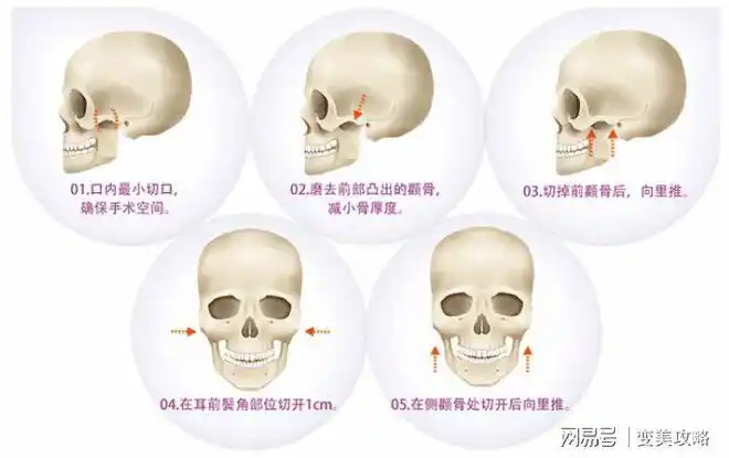 一文看懂削骨换脸的技术