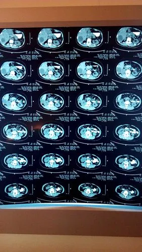 胆囊癌or胆管癌