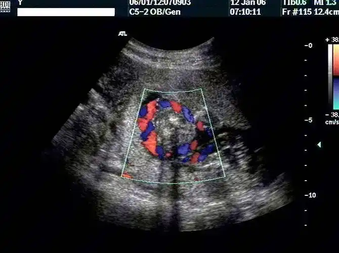 52:48 胎儿纵切面见"u"形脐带压迹,横切可见脐带呈360度彩色血流环绕