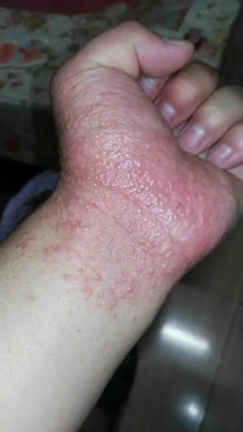 去医院检查过说是过敏,可是这么多天了越来越多的水泡不见好转!