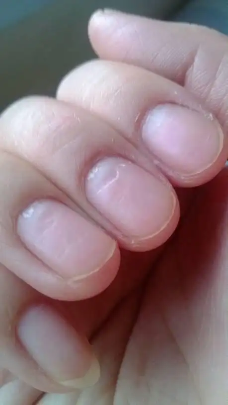 不知道是缺什么微量元素还是有病,现在 20 麻烦看一下我的指甲,凹陷挺