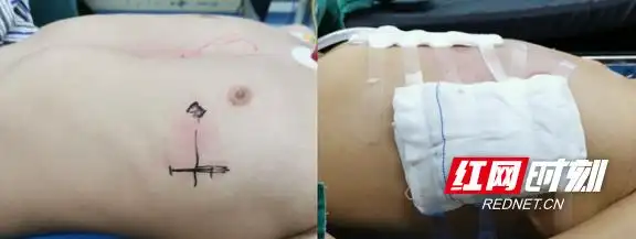 术前术后对比,胸前区凹陷畸形得到明显的改善.