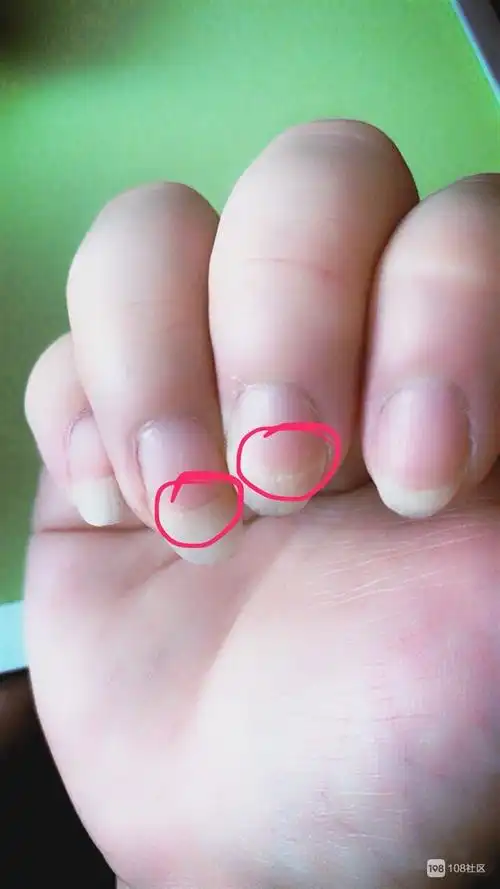 指甲无缘无故的出现这种问题,我是不是得什么病了?