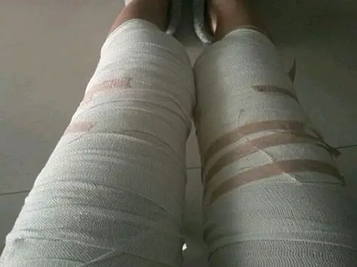 醒来之后,看着自己的腿缠满了纱布,看起来好好笑,然_圈子-新氧美容