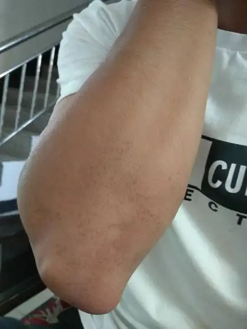 手臂上出现的这种斑点是怎么回事?