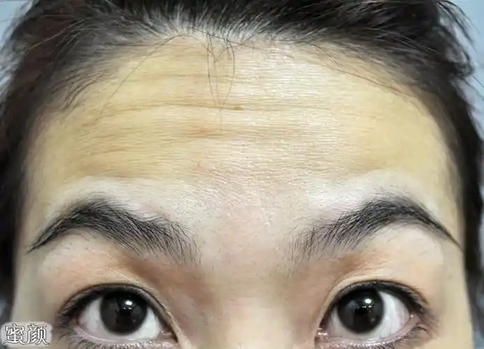 【美然】额头上有皱纹怎么办?教你除皱小妙招!