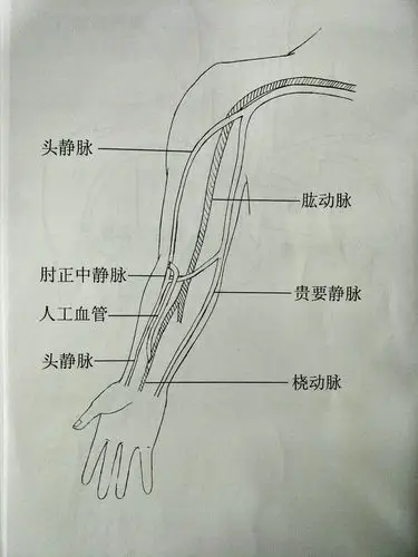 avg(j型) 右侧 上臂头静脉-桡动脉 吻合(↓)