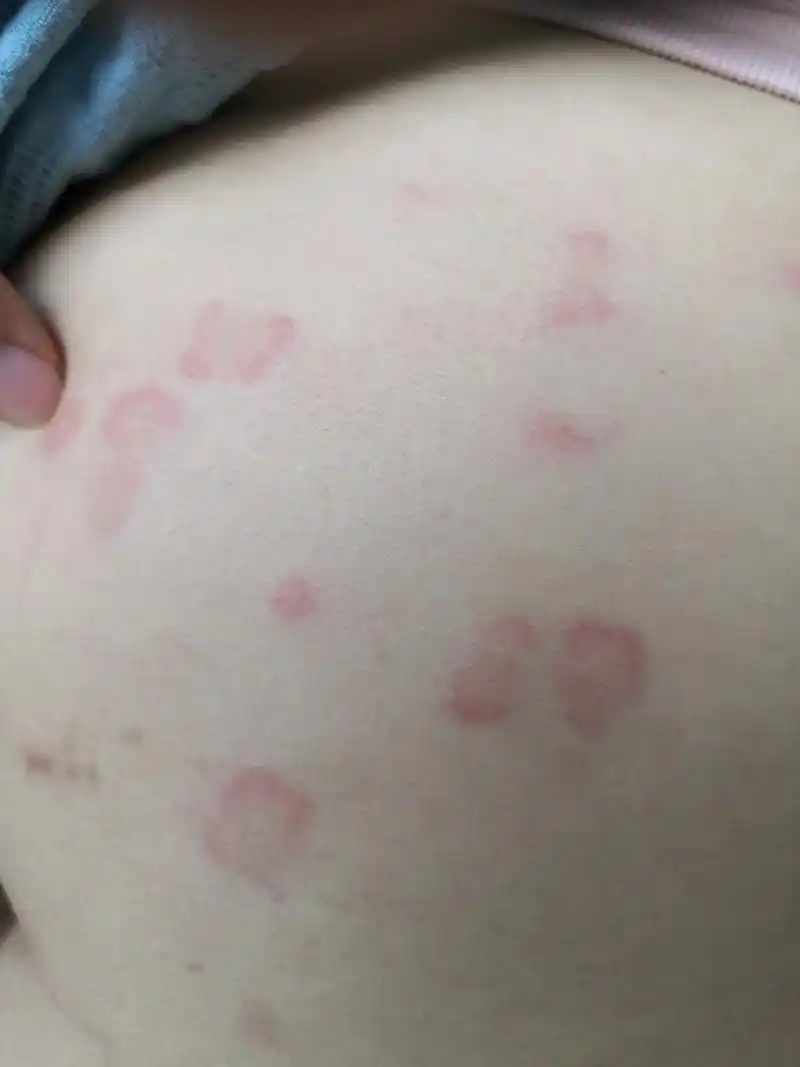 考虑荨麻疹症状#解决皮肤问题专注皮肤美容# 排查一下药物过敏导致的